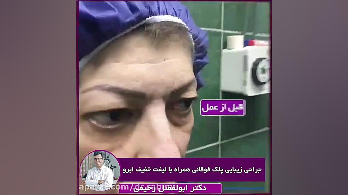 جراحی زیبایی پلک و لیفت ابرو هولوگرام سه‌بعدی جراحی