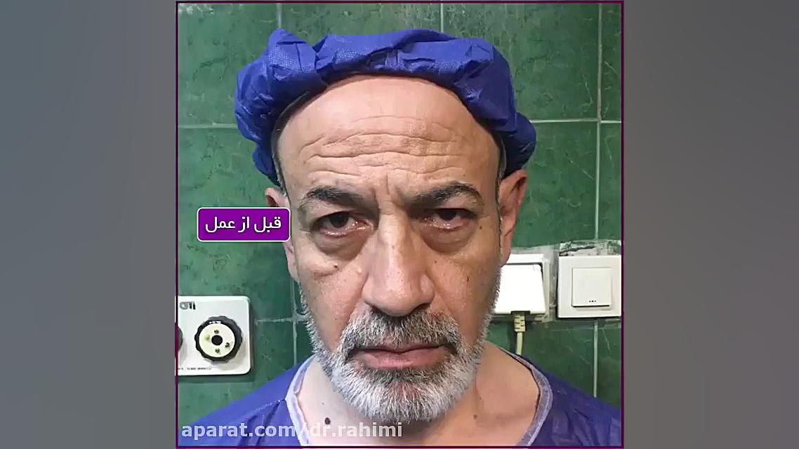جراحی پلک فوقانی و لیفت ابرو به مقدار خفیف کامپوزیت ونیر