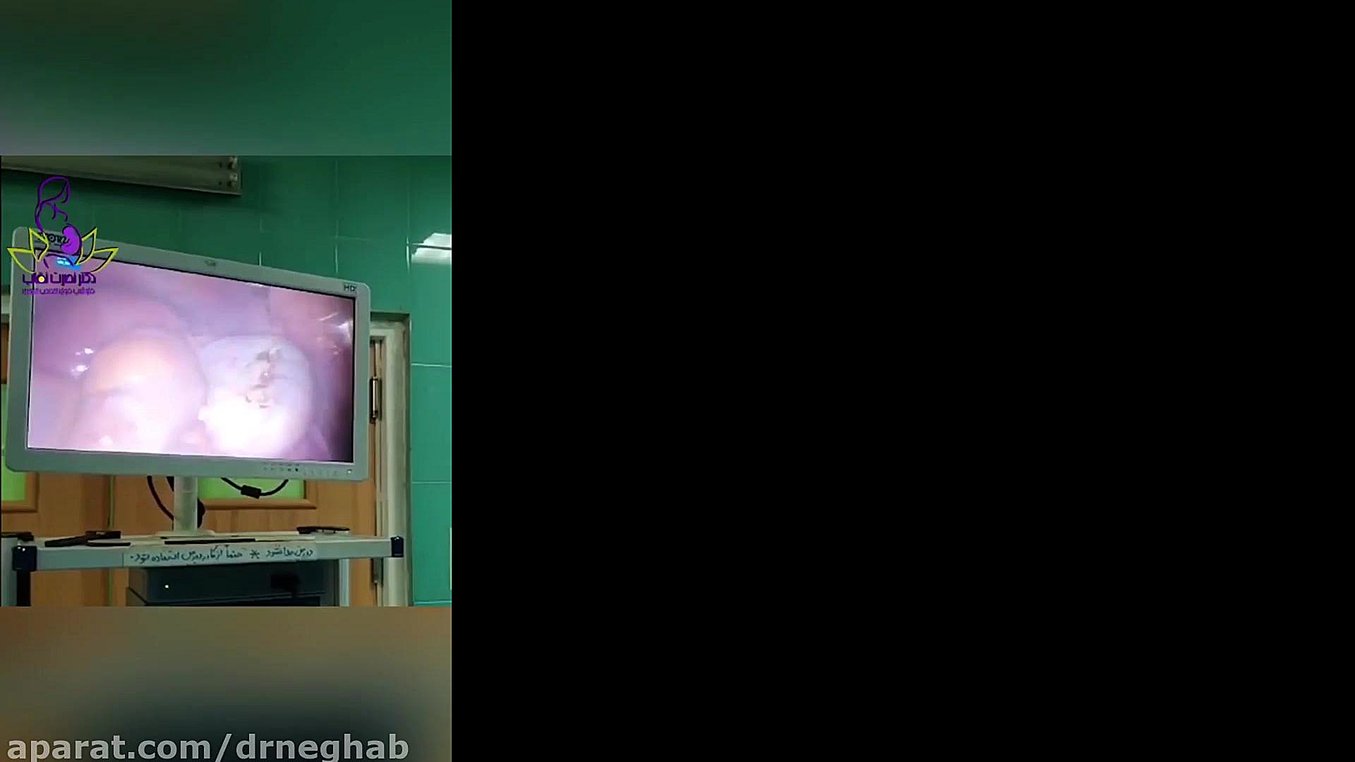 فیلم کوتر تخمدان در فرد نابارور با سندروم تخمدان پلی کیستیک ترمیم لبخند لثه‌ای
