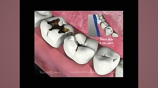 پوسیدگی دندان دکتر عبدالرضا جمیلیان - متخصص ارتودنسی
