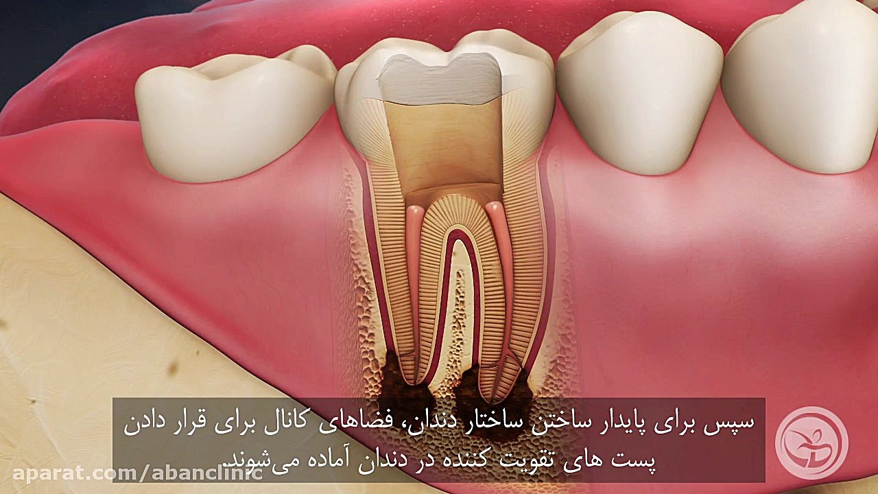 آشننایی با درمان ریشه، عصب کشی، روت کانال بیماری کیانسروماتوز صفاقی