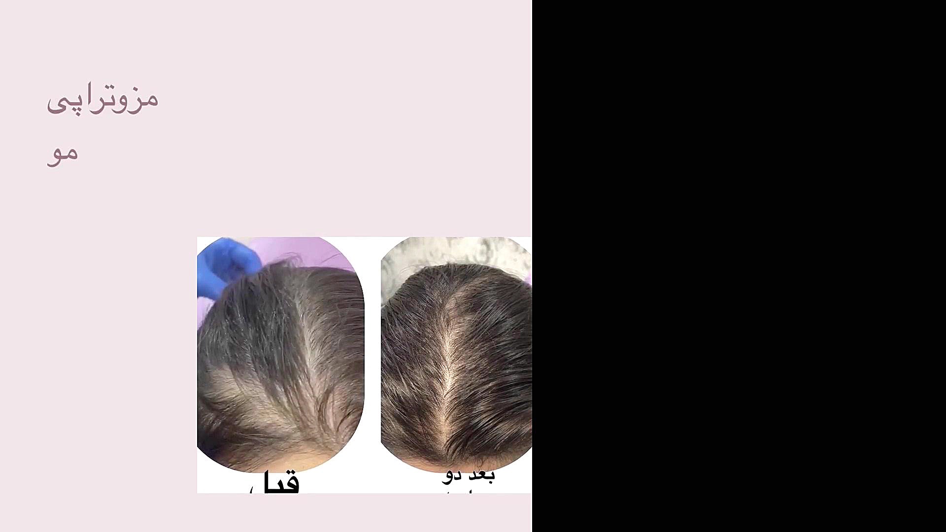 مزو تراپی درمان ریزش مو دکتر عاطفه گلفشان، متخصص پوست مو و لیزر درمانی