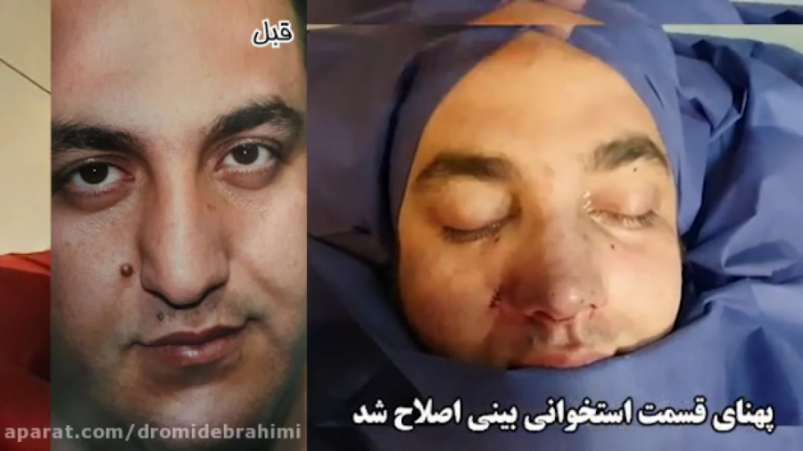 عمل بینی گوشتی کج توسط دکتر امید ابراهیمی بهترین جراح بینی گوشتی در تهران دکتر امید ابراهیمی