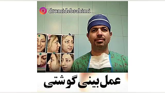 عمل بینی گوشتی توسط دکتر امید ابراهیمی بهترین جراح بینی گوشتی در تهران دکتر امید ابراهیمی
