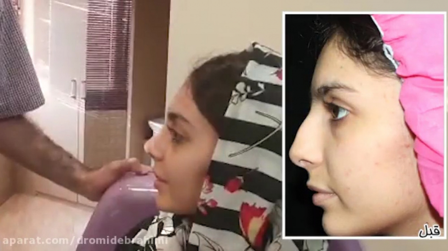 رضایتمندی بیمار بعد از عمل بینی استخوانی توسط دکتر امبد ابراهیمی دکتر امید ابراهیمی