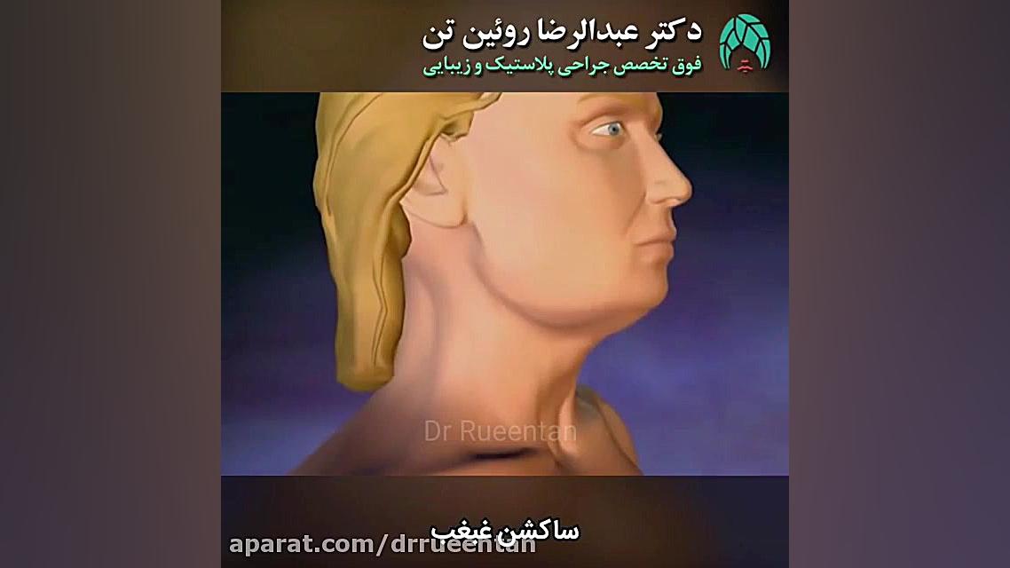 ساکشن غبغب | فوق تخصص جراحی پلاستیک | دکتر عبدالرضا روئین تن دکتر عبدالرضا روئین تن