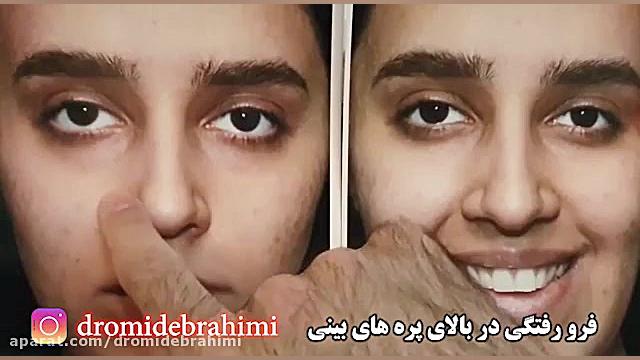 عمل بینی استخوانی و اصلاح قوز بینی توسط دکتر امید ابراهیمی بهترین جراح بینی دکتر امید ابراهیمی