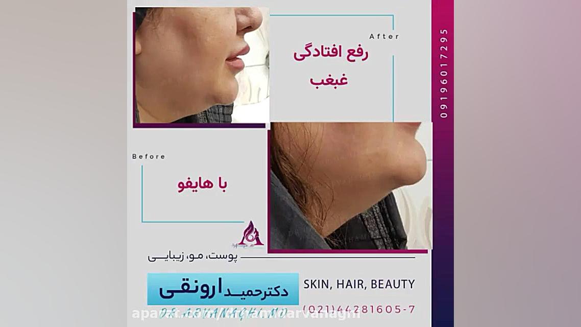 فیلم قبل و بعد رفع افتادگی غبغب با هایفوتراپی بیماری آلبومینوری وراثتی
