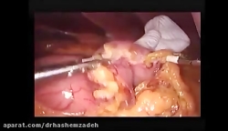 مراحل عمل اسلیو ساسی توسط دکتر...