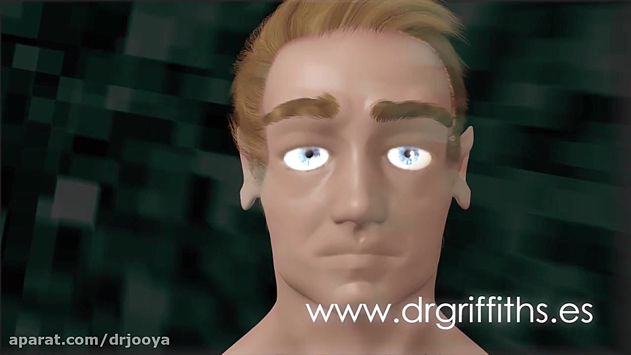 کاشت مو FUE دکتر ابوالفضل جویا
