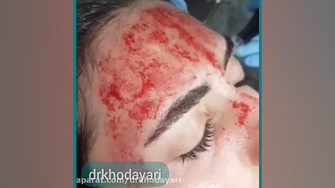 فیلم میکرونیدلینگ صورت در کلینیک دکتر خدایاری پزشکی ویرایش ژن