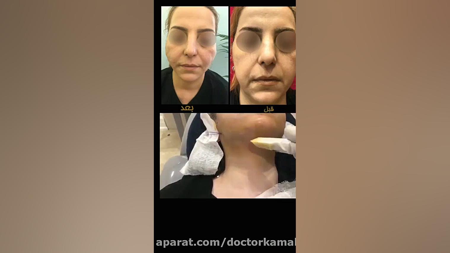 فیلم واقعی لیفت صورت با نخ آوتوپلیسوماب