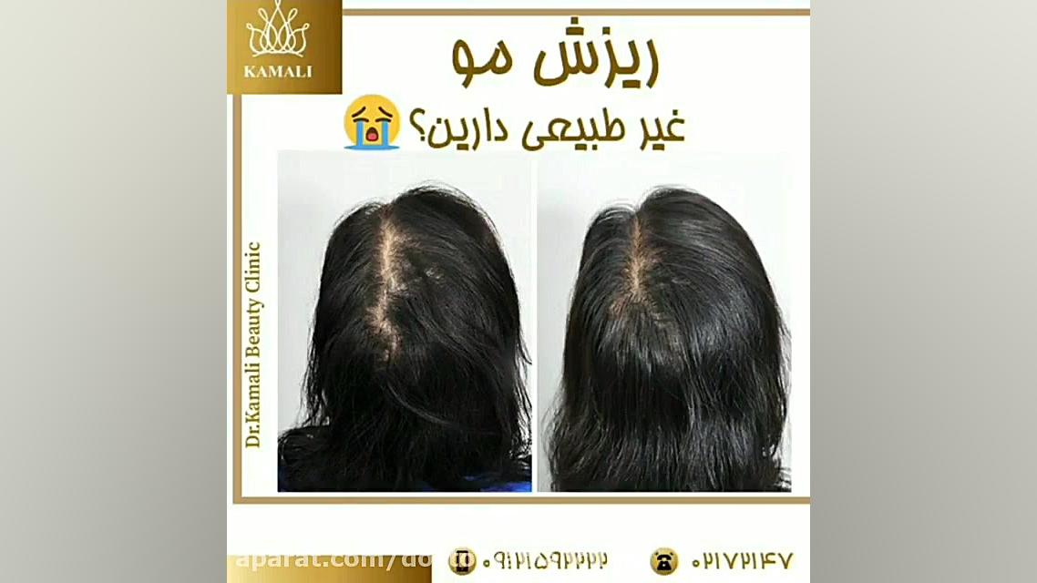 فیلم درمان ریزش مو غیر طبیعی ریتوکسیمب-هایبرید