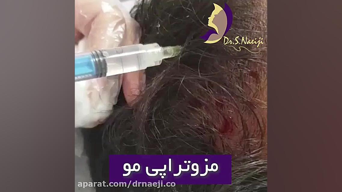 فیلم واقعی مزوتراپی مو دکتر صدیقه نائیجی | متخصص پوست و مو در قم