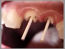 بازسازی دندان با استفاده از پس...