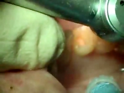 ساخت پست و کور دندان با پست فل...