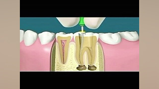 روکش دندان دکتر عبدالرضا جمیلیان - متخصص ارتودنسی