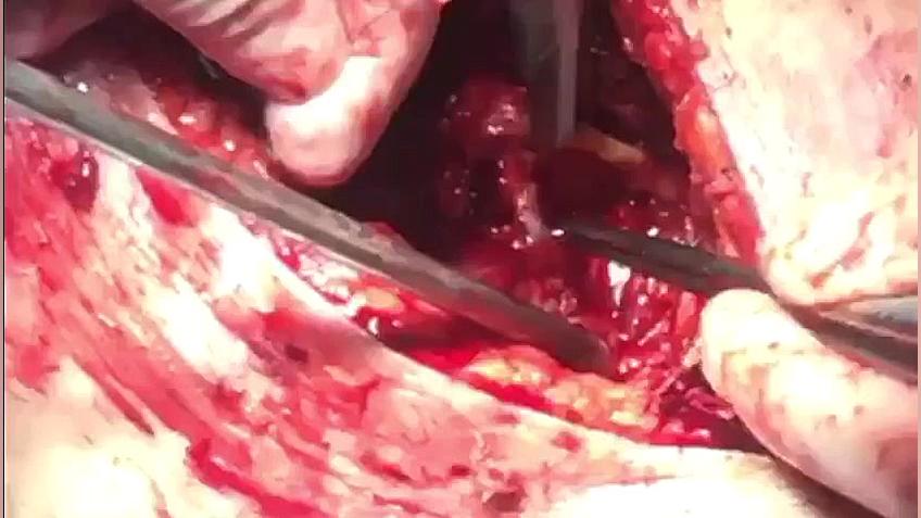عمل آنوریسم پاره شده شريان فمورال مزوتراپی