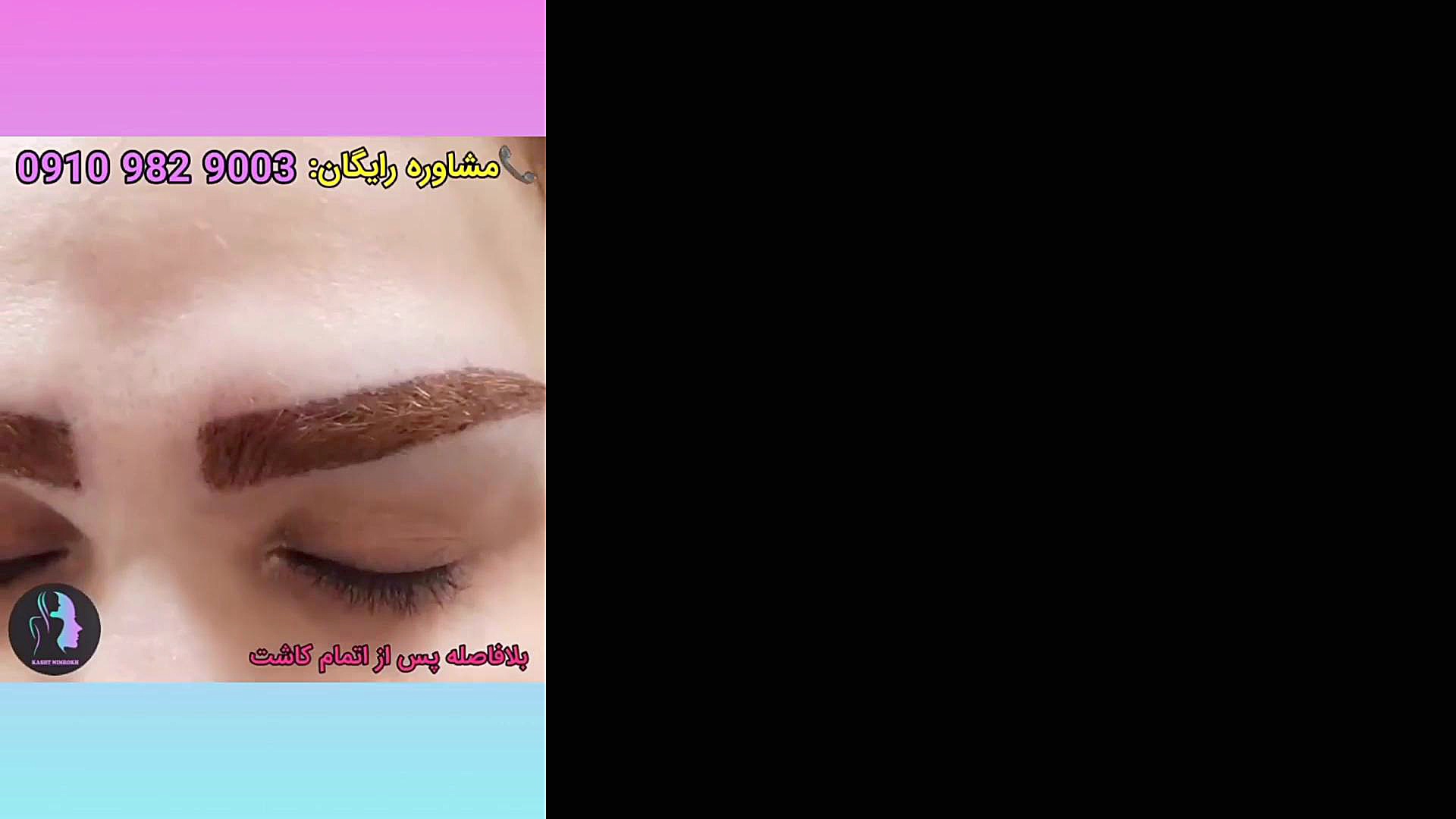 کاشت ابرو طبیعی بیماری بهجت