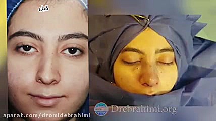 جراحی بینی استخوانی انحراف دار توسط دکتر امید ابراهیمی بهترین جراح بینی در تهران دکتر امید ابراهیمی