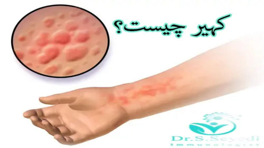 کهیر چیست؟ دکتر شهرام سیدی متخصص آلرژی و ایمونولوژی