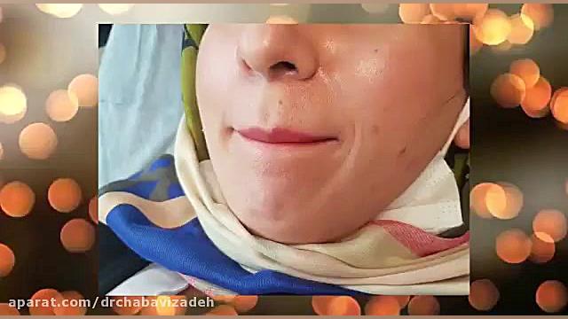 فیلم واقعی برداشتن خال با لیزر دکتر صفیه چعباوی زاده