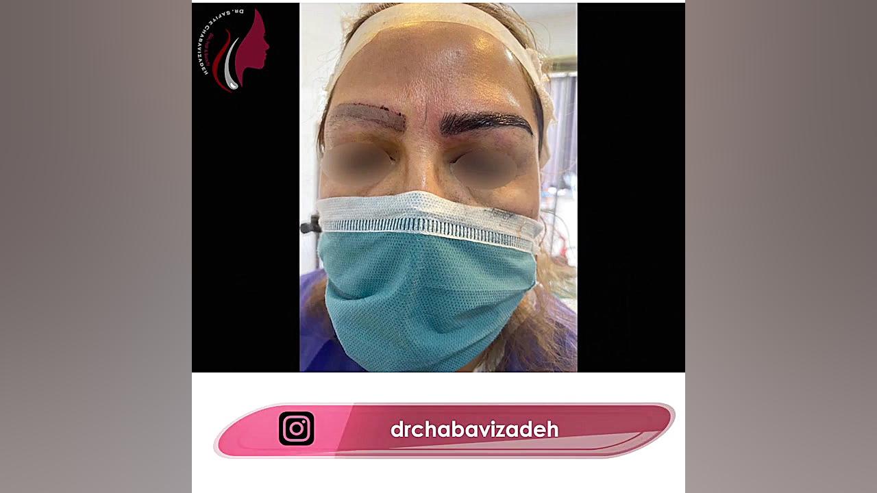 فیلم واقعی کاشت ابرو دکتر صفیه چعباوی زاده