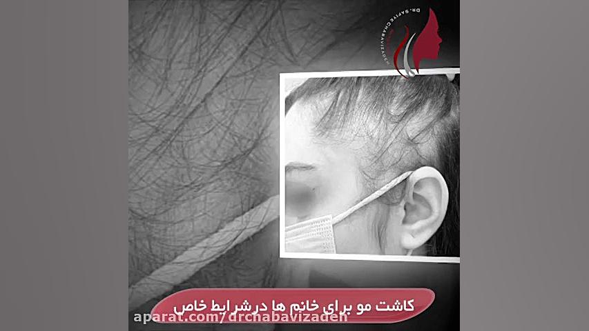 فیلم واقعی کاشت مو برای خانم ها در شرایط خاص دکتر صفیه چعباوی زاده