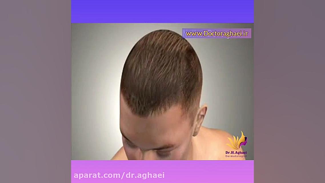 فیلم واقعی از نحوه کاشت مو دکتر حمیده آقایی