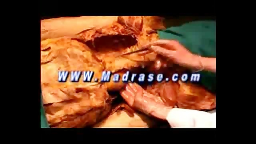 قلب و جایگاهش در قفسه سینه جراحی زیبایی پلک