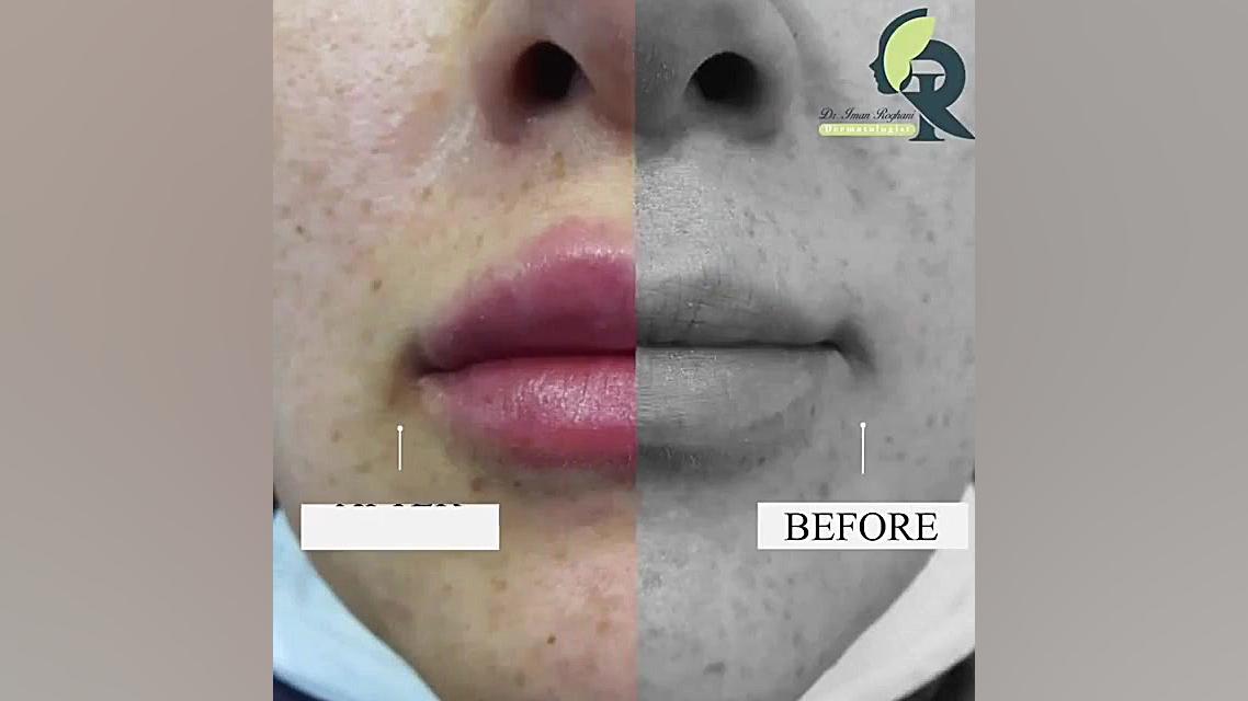 تزریق ژل به لب توسط دکتر ایمان روغنی دکتر ایمان روغنی جراح و متخصص پوست و مو