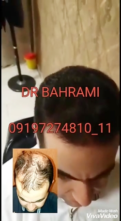 دیگر نیازی به کاشت مو نیست