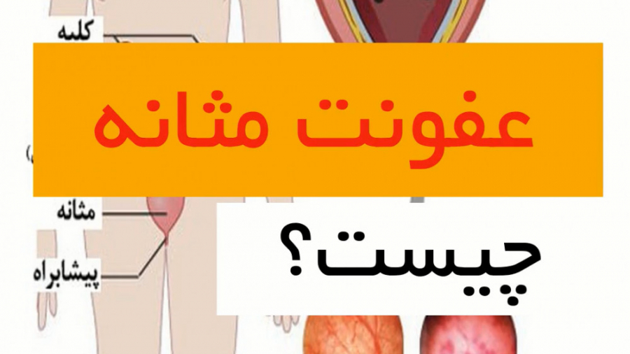 عفونت مثانه _ دکتر سیدامین میرصادقی تزریق ژل