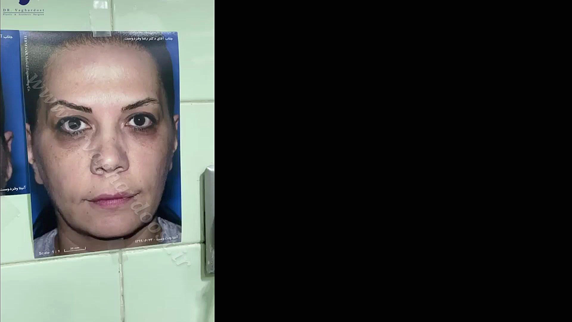لیفت ابرو و تزریق چربی زیر چشم آکنه