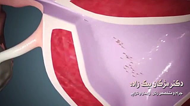 فیلم حاملگی خارج از رحم دکتر مژگان بیک زاده ( جراح و متخصص زنان و زایمان)