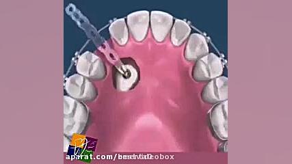 حرکت دندان نیش نهفته داخل فک به سمت قوس دندانى687 کربوکسی تراپی