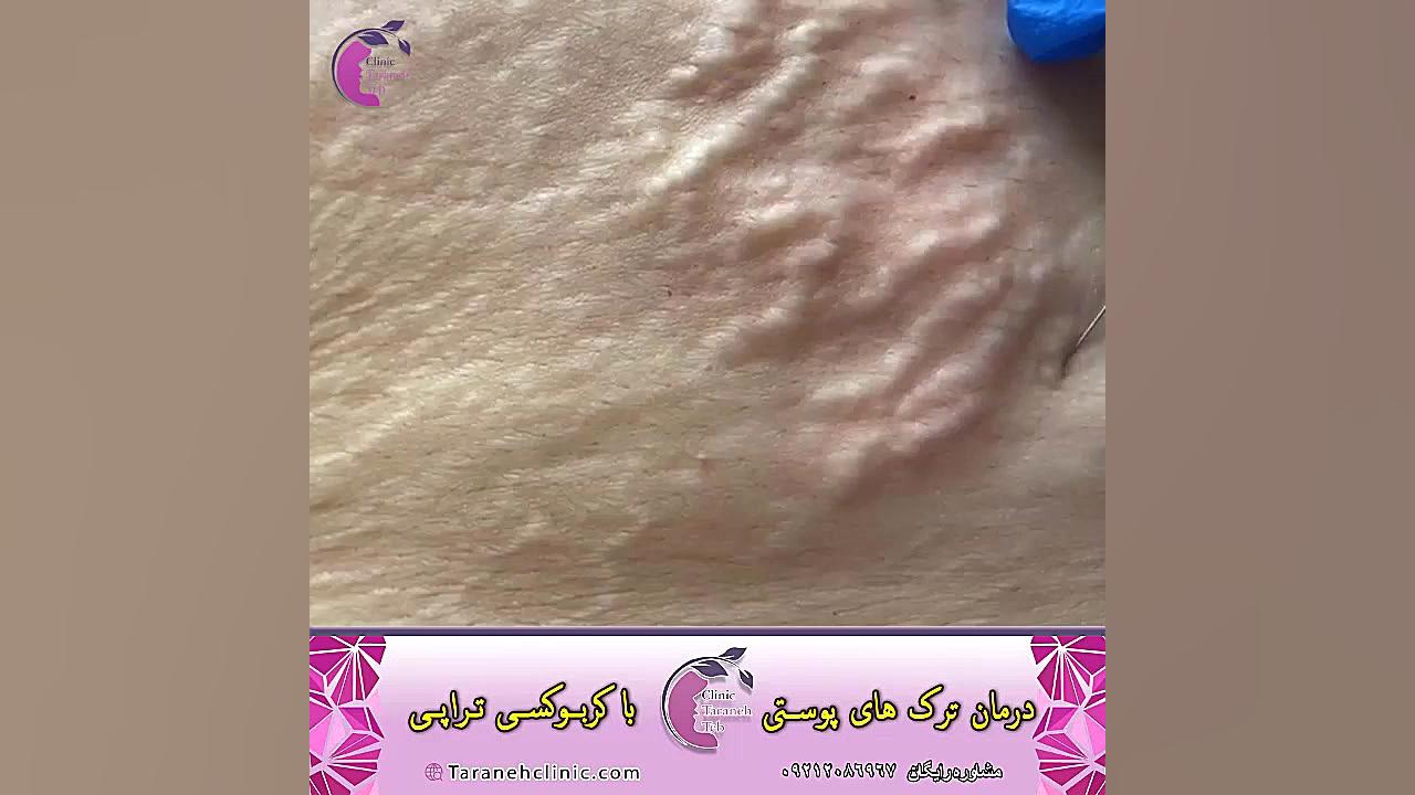 کربوکسی تراپی شکم درمان مهاری پیوندی