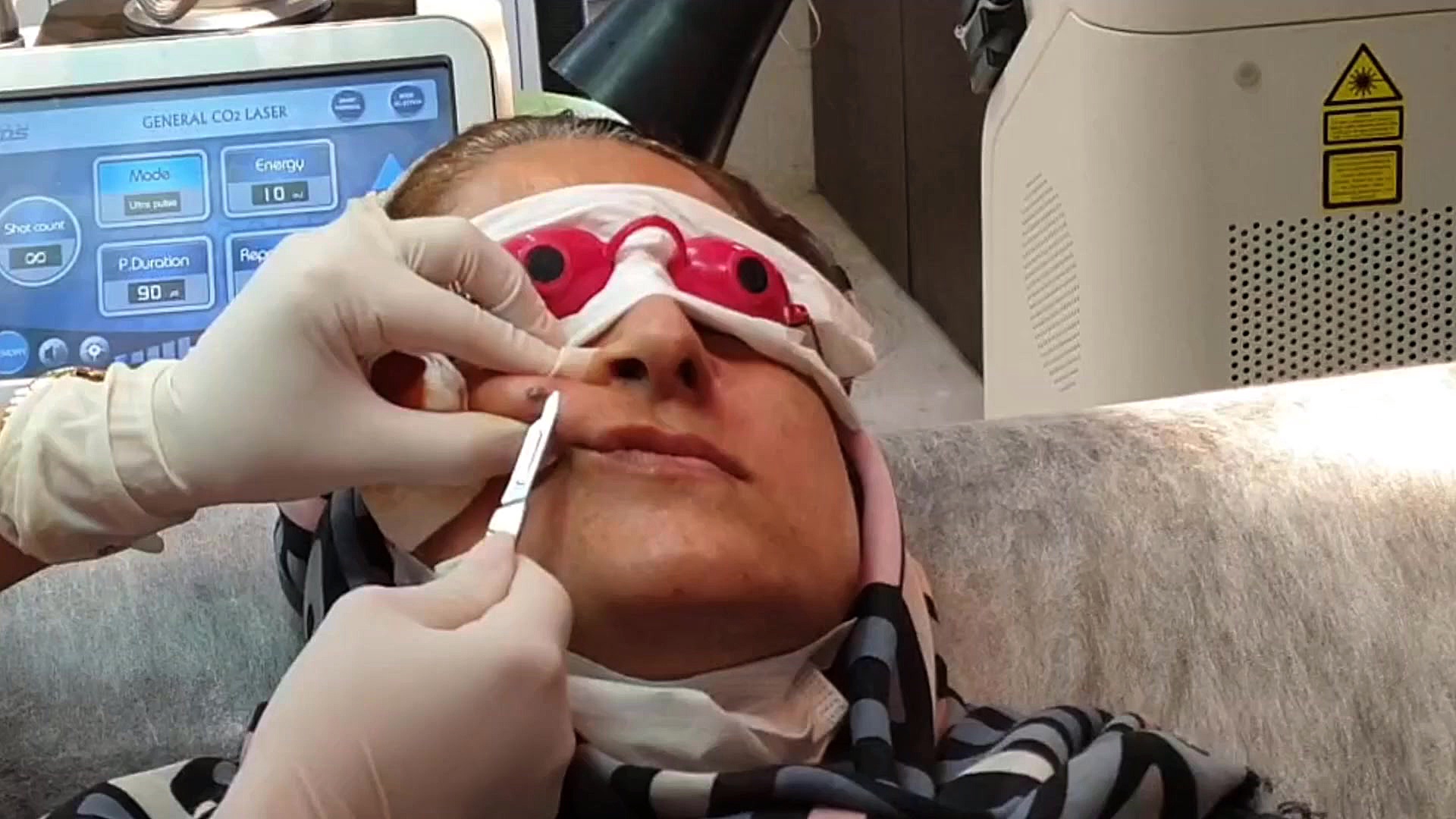 برداشتن خال با لیزر دکتر مریم ملکی - کلینیک پوست و مو و زیبایی هور