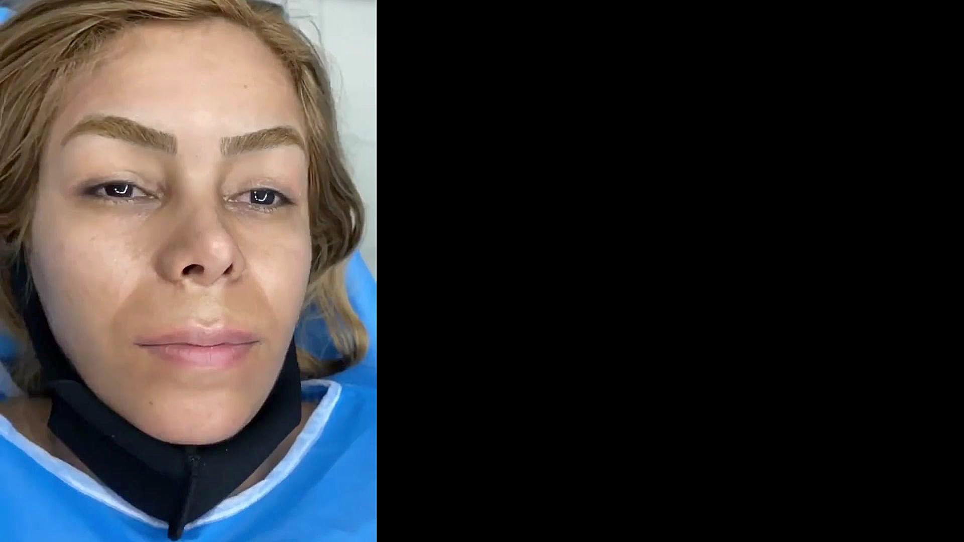 لیفت اندوسکوپیک پیشانی با اندوتاین هیدروراکس