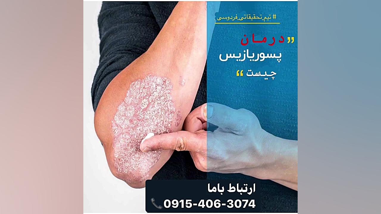 درمان بیماری پسوریازیس بدون استفاده از کورتون ارتودنسی