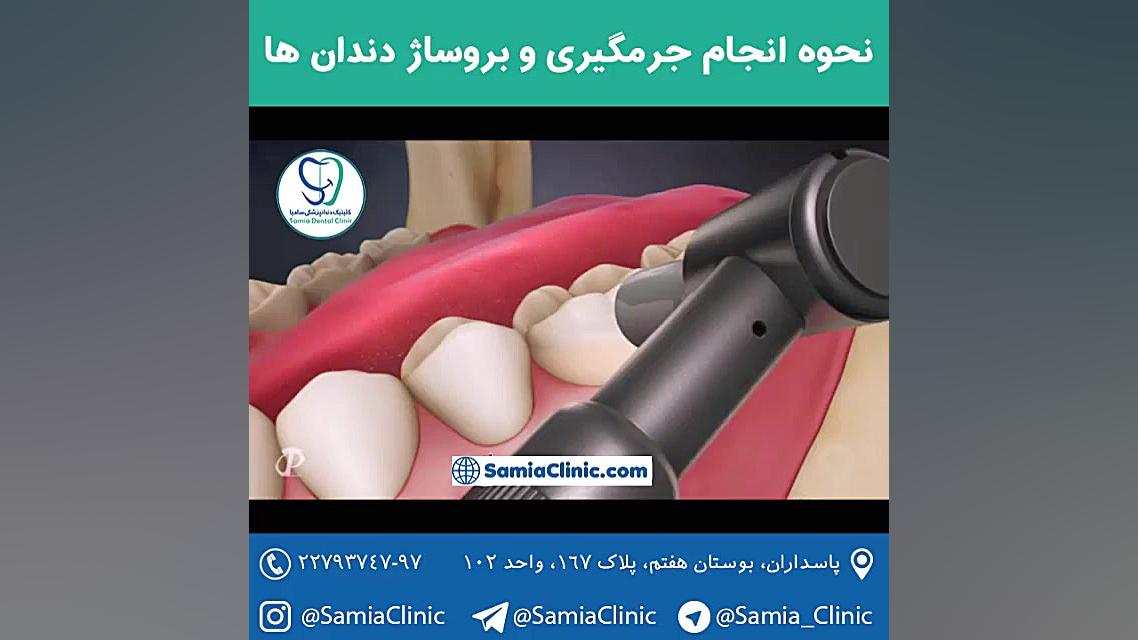 جرمگیری دندان ها لیفت ابرو