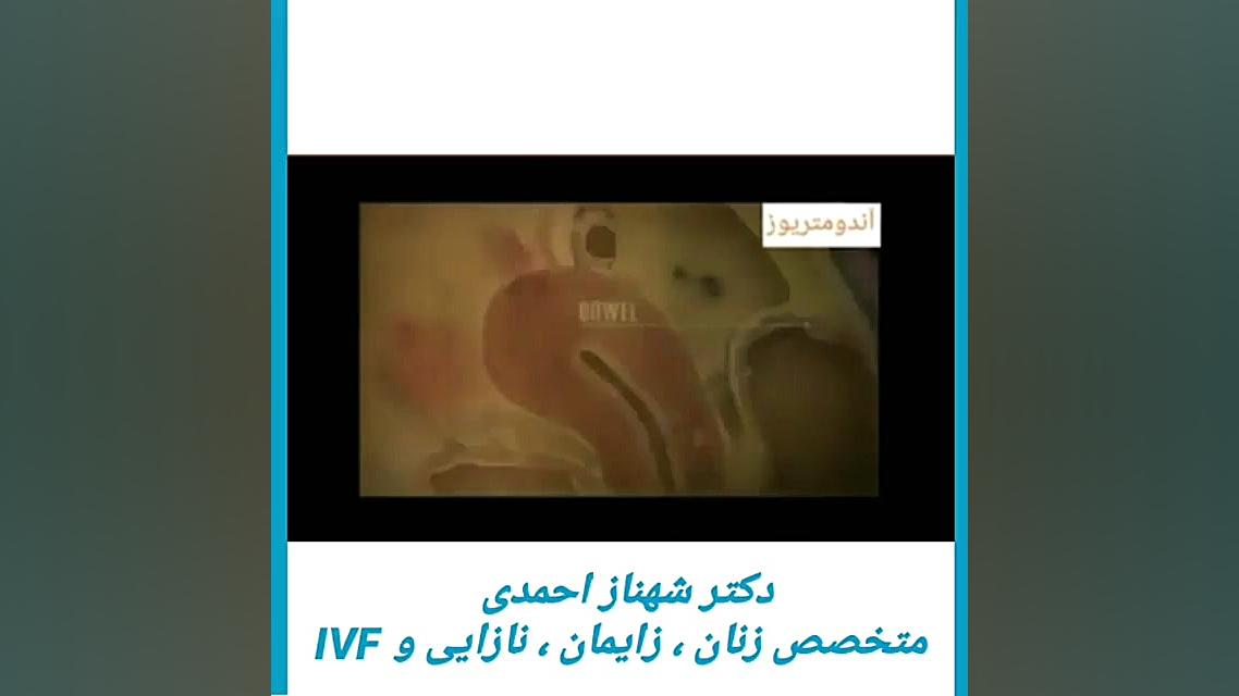 اندومتریوز دکتر شهناز احمدی