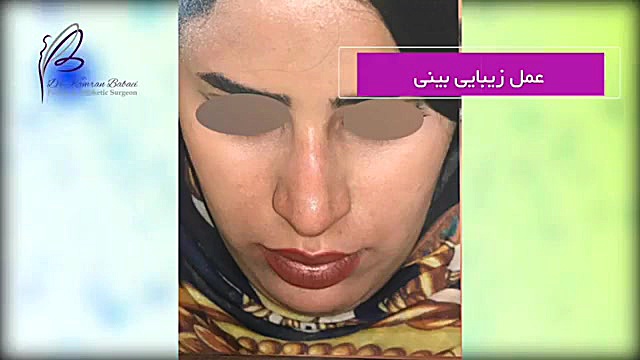 فیلم واقعی از زیبایی بعد از عمل بینی دکتر کامران بابایی