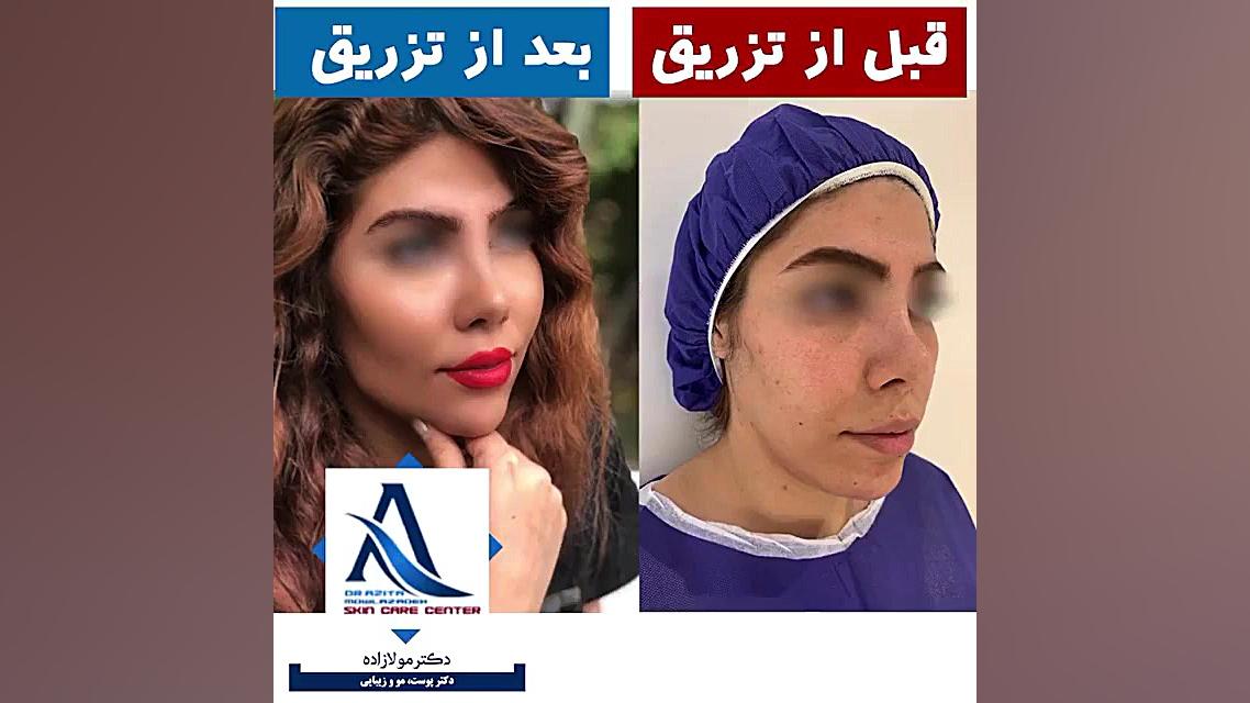 فیلم تزریق چربی به گونه، چانه و زاویه سازی فک لیفت گردنایمپلنت دندان