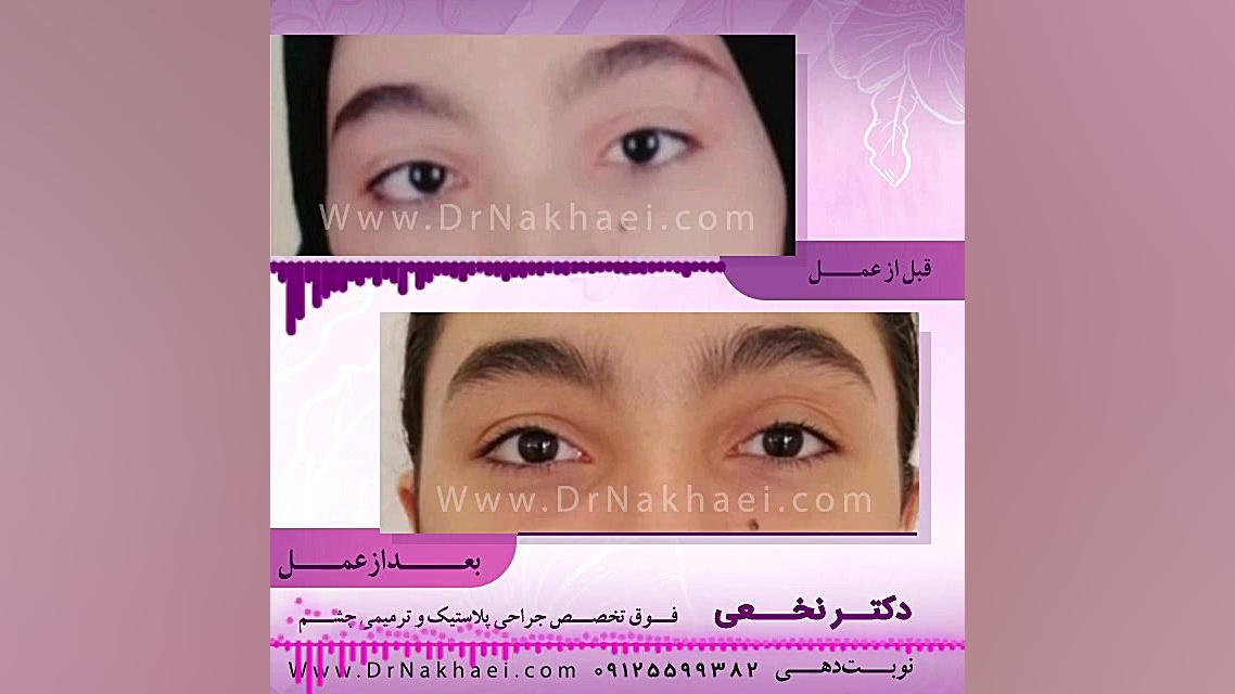 فیلم نمونه واقعی جراحی انحراف چشم در دختر خانم ۱۵ ساله دندان مصنوعی