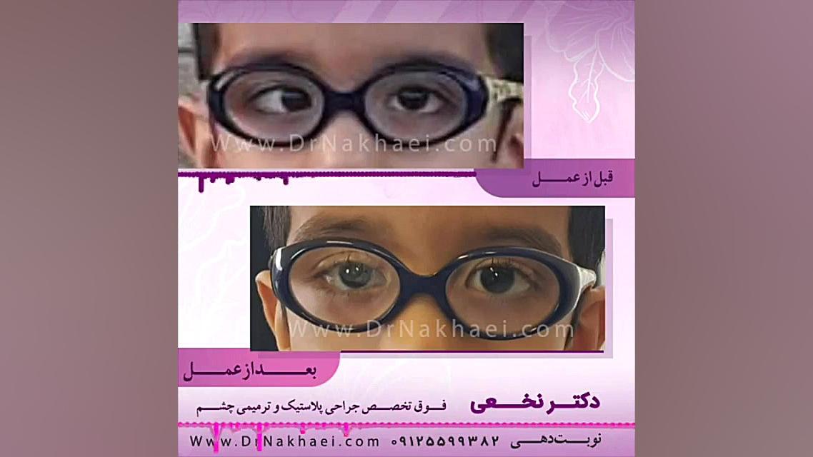 فیلم نمونه واقعی جراحی انحراف چشم در کودک ۵ ساله بیماری پلی‌سیتمی ورا