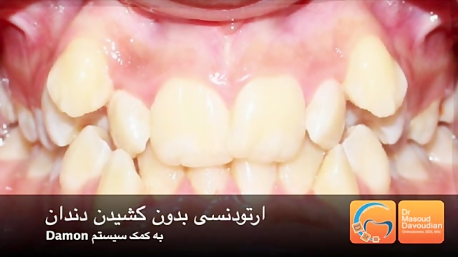 ارتودنسی نامرتبی شدید بدون کشیدن دندان | دکتر داودیان DLCO