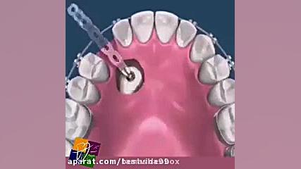 حرکت دندان نیش نهفته داخل فک به سمت قوس دندانى1687 ایکلوزوماب