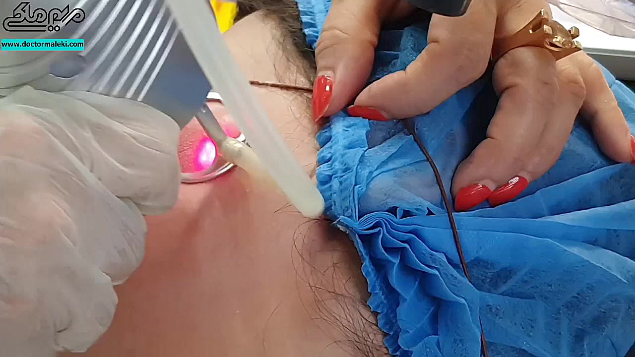 لیزر فرکشنال اسکار دکتر مریم ملکی - کلینیک پوست و مو و زیبایی هور