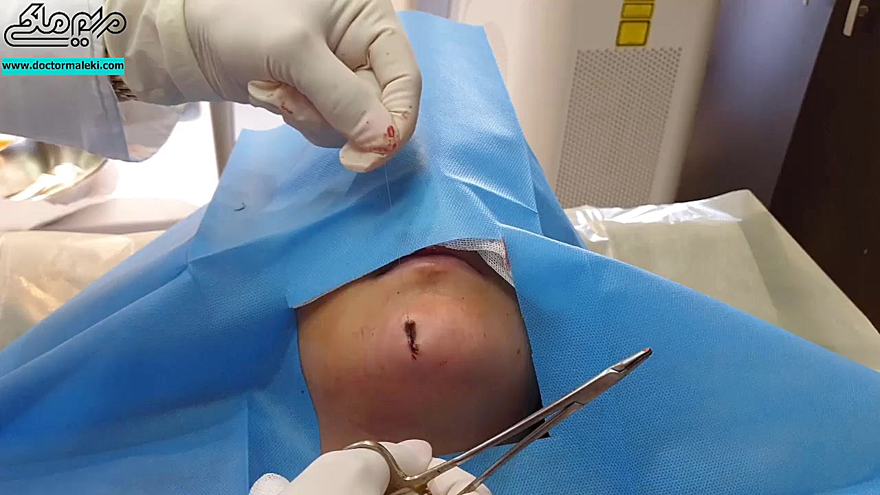 جراحی خال دکتر مریم ملکی - کلینیک پوست و مو و زیبایی هور